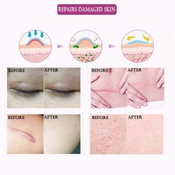 Scar removal & acne treatment - lavender massage oil 10 mlMassage