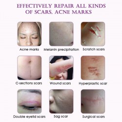 Scar removal & acne treatment - lavender massage oil 10 mlMassage