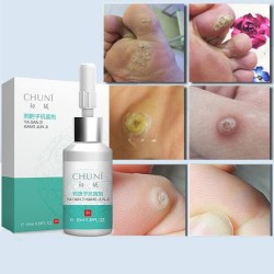 Liquid for removing skin tags - moles - warts - lightening freckles - 10ml