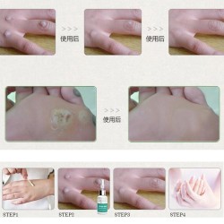 Mole Skin Tag Repair Solution Painless Mole Skin Dark Spot Repair Face Wart Tag Freckle Repair Cre