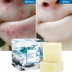 Honigseife - Ziegenmilch - Acne entfernen - Clean Skin - Blackhead Remover