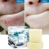 Honigseife - Ziegenmilch - Acne entfernen - Clean Skin - Blackhead Remover