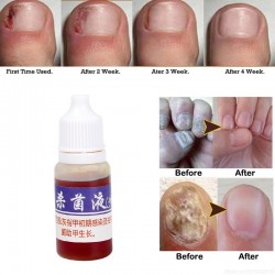 Chinesische Medizin - Nagelreparatur bei Onychomykose - Nagelpilz - 10 ml