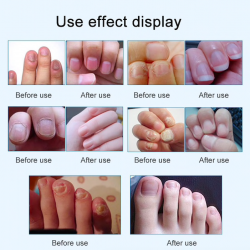 15ml - Nagelpilzbehandlung - Entfernung - Nagelreparaturflüssigkeit