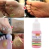 Entfernung von Hautflecken – Fußwarzen – medizinische Flüssigkeit – 10 ml – 2 Stück